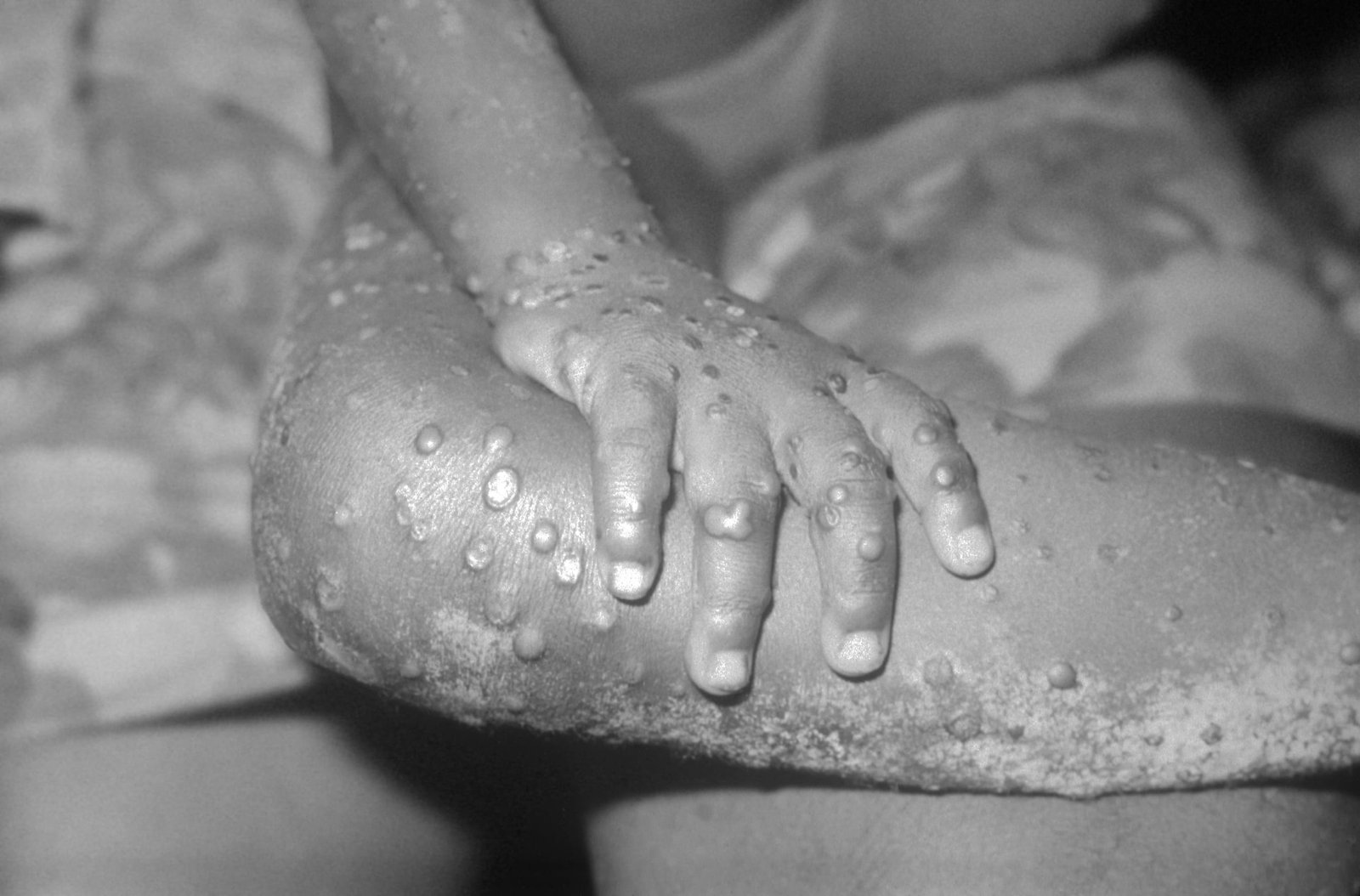 WHO Declares Mpox Outbreak in Africa a Public Health Emergency