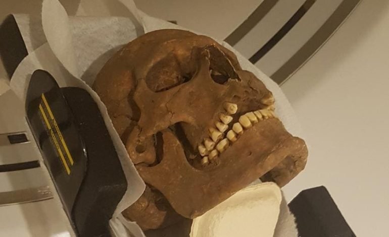 Viking skulls undergoing CT scan analysis, revealing signs of disease and skeletal conditions.