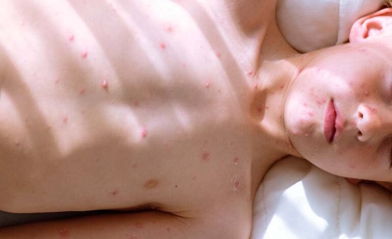 NHS chickenpox vaccine: routine MMRV jab to start from January 2026